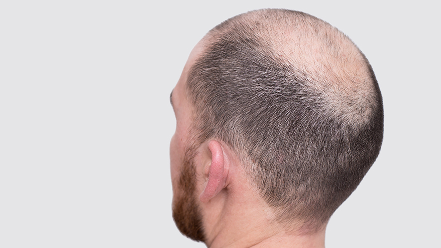 Everything You Need to Know About Hair System (17)