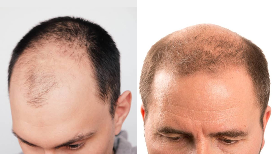 Everything You Need to Know About Hair System (18)