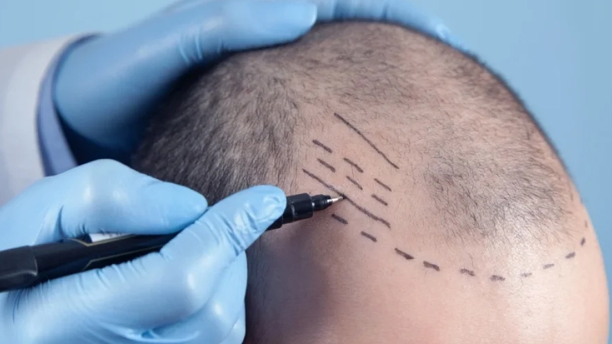 Everything You Need to Know About Hair System (19)