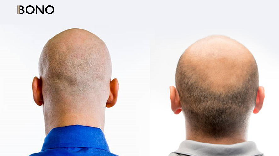 Men’s Hair Regrowth Secrets You Never Knew (20)