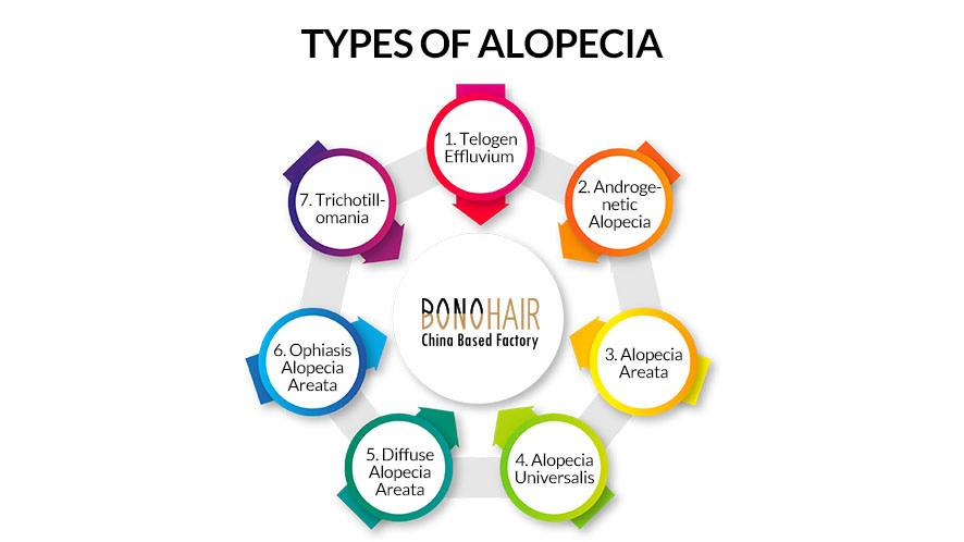 What is Alopecia and Alopecia Treatment (12)