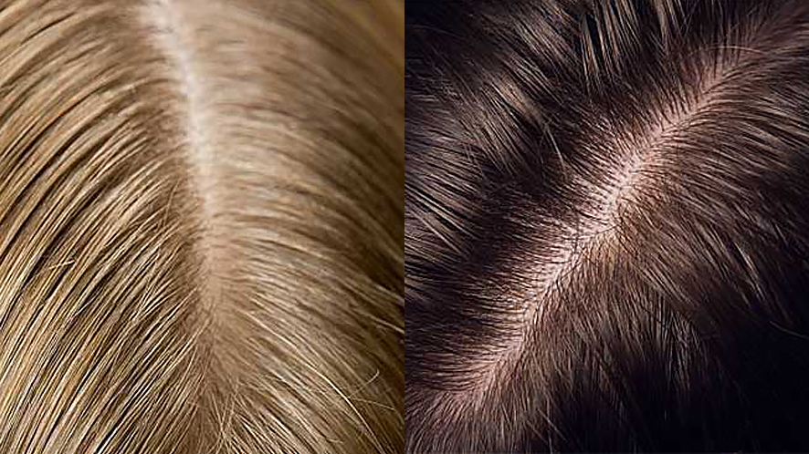 CAN SHAMPOO CAUSE HAIR LOSS AND WHAT INGREDIENTS IN SHAMPOO CAUSE HAIR LOSS (7)