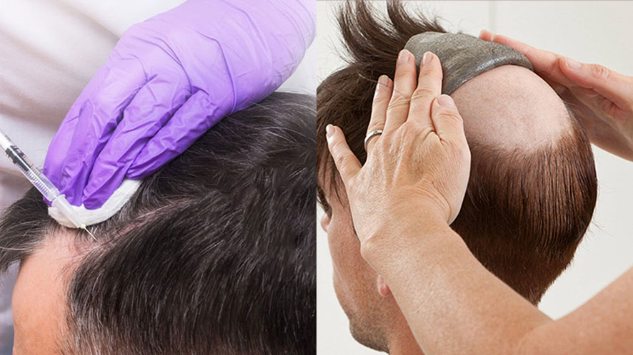 A Complete Guideline To Non-surgical Hair Restoration (12)