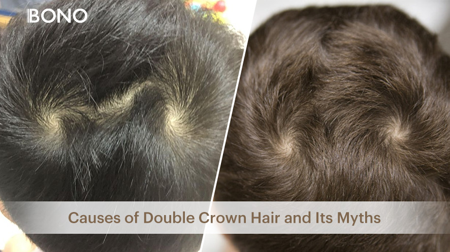 Causes of Double Crown Hair and its Myths (3)